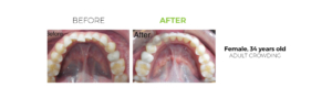 Before and After, Female Invisalign Patient