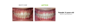 Before and After, Adult Invisalign Patient